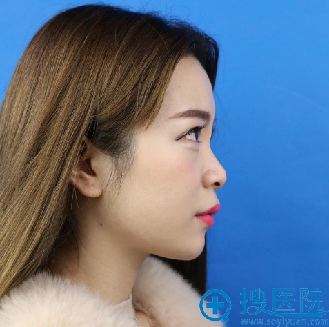 来<!--<i data=20240710 data-id=14384></i>-->整形医院做鼻子前的照片 来<!--<i data=20240710 data-id=14384></i>-->整形医院做鼻子前的照片