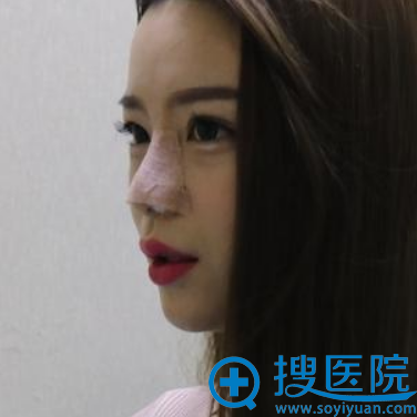 <!--<i data=20240710 data-id=14384></i>-->杨帆院长隆鼻术后即刻效果图 <!--<i data=20240710 data-id=14384></i>-->杨帆院长隆鼻术后即刻效果图