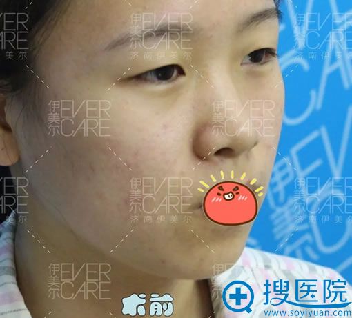 索性找济南伊美尔王清峰和关迪剑医生把双眼皮和隆鼻一下做了