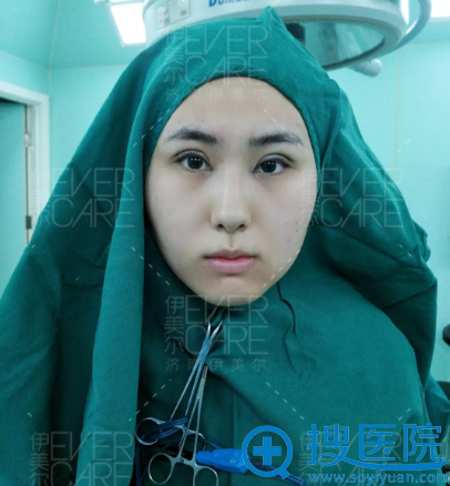 找<!--<i data=20240710 data-id=12670></i>-->王清峰全切双眼皮术后即刻效果图 找<!--<i data=20240710 data-id=12670></i>-->王清峰全切双眼皮术后即刻效果图
