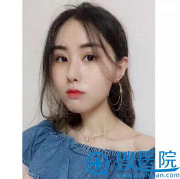 <!--<i data=20240710 data-id=12670></i>-->双眼皮案例七天拆线效果 <!--<i data=20240710 data-id=12670></i>-->双眼皮案例七天拆线效果