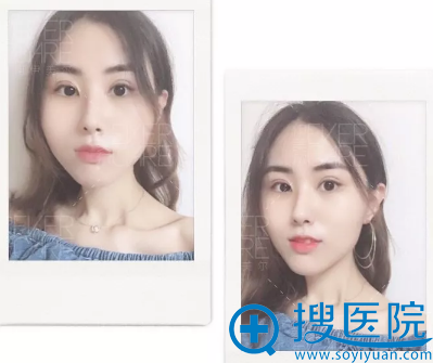 不知不觉在<!--<i data=20240710 data-id=12670></i>-->做完双眼皮十天了 不知不觉在<!--<i data=20240710 data-id=12670></i>-->做完双眼皮十天了