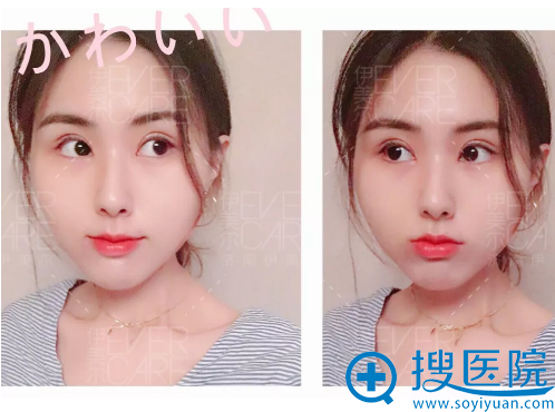 <!--<i data=20240710 data-id=12670></i>-->王清峰主任双眼皮两周恢复效果图 <!--<i data=20240710 data-id=12670></i>-->王清峰主任双眼皮两周恢复效果图