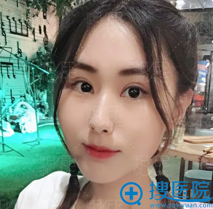 <!--<i data=20240710 data-id=12670></i>-->王清峰全切双眼皮案例一个月效果图 <!--<i data=20240710 data-id=12670></i>-->王清峰全切双眼皮案例一个月效果图