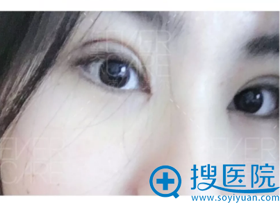 <!--<i data=20240710 data-id=12670></i>-->全切双眼皮和开眼角三天细节图 <!--<i data=20240710 data-id=12670></i>-->全切双眼皮和开眼角三天细节图