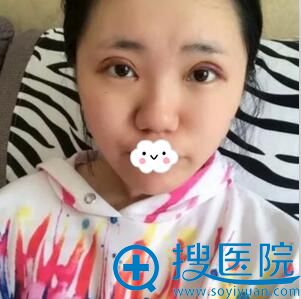 太原华美切开双眼皮+开眼角术后效果 太原华美切开双眼皮+开眼角术后效果