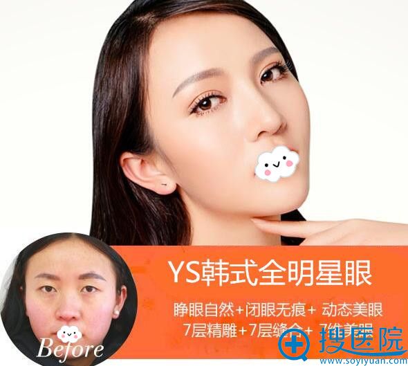 真人案例看呼和浩特伊思双眼皮开眼角祛眼袋效果好还是大韩更好