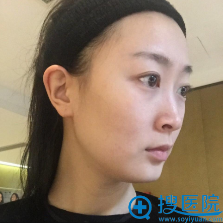 看了四川华美紫馨邱伟和陈杨的隆鼻案例后找徐鹏做了肋软骨隆鼻