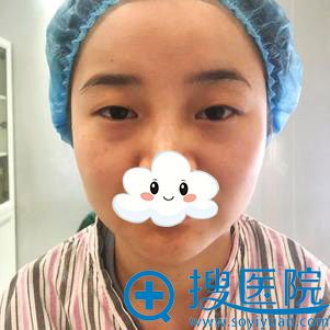 暑假找重庆好美李曾显医生给我做的双眼皮+开眼角27天效果