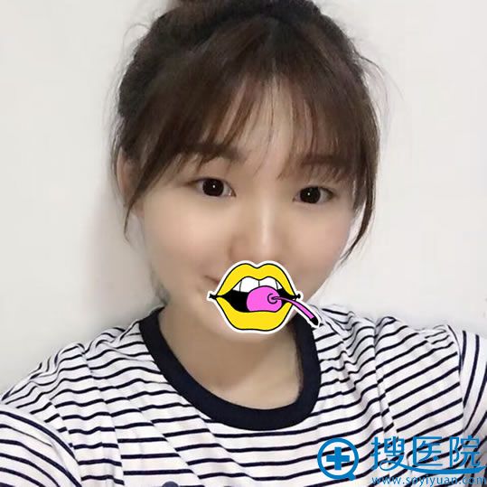 在赣州华美整形医院做双眼皮前 在赣州华美整形医院做双眼皮前