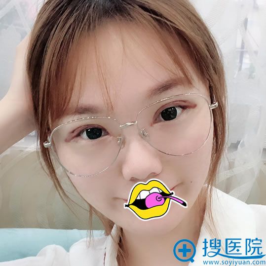 选择赣州华美赵亚均做双眼皮当天 选择赣州华美赵亚均做双眼皮当天