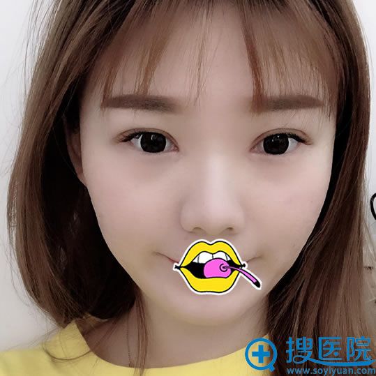 在赣州华美做完双眼皮开眼角15天后 在赣州华美做完双眼皮开眼角15天后