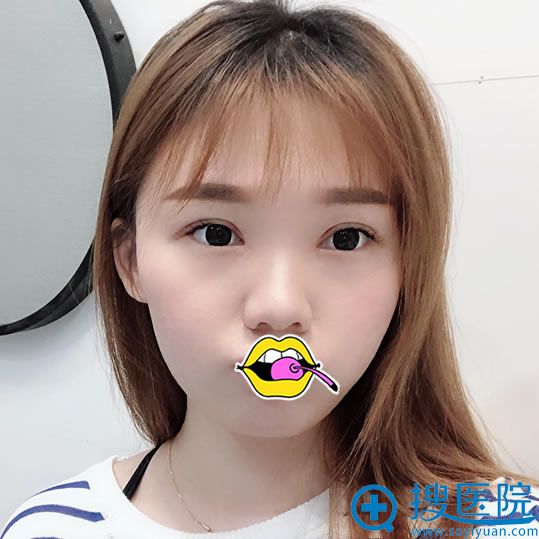赣州华美赵亚钧双眼皮案例效果 赣州华美赵亚钧双眼皮案例效果