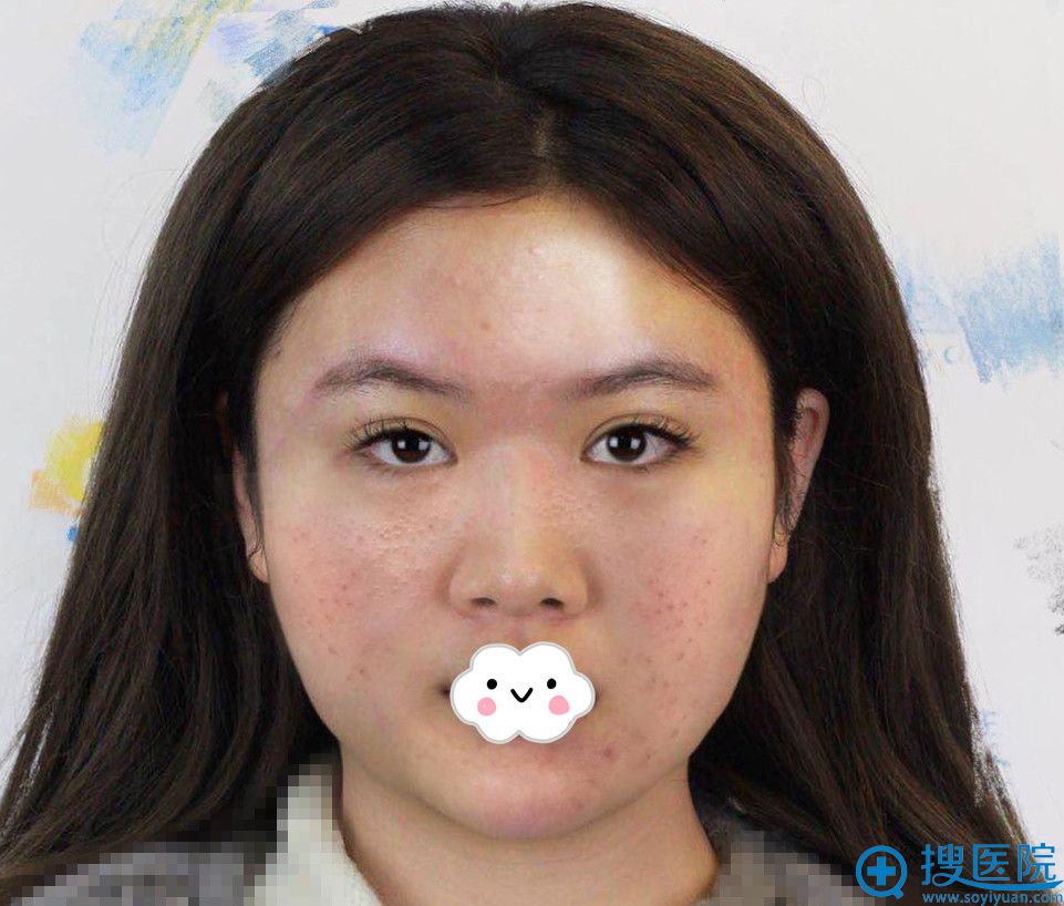 谁说假体隆鼻不能分期付款?我给石家庄苏亚美联臣月供194元