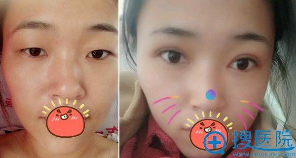 <!--<i data=20240710 data-id=12686></i>-->整形张行双眼皮和开眼角案例 <!--<i data=20240710 data-id=12686></i>-->整形张行双眼皮和开眼角案例