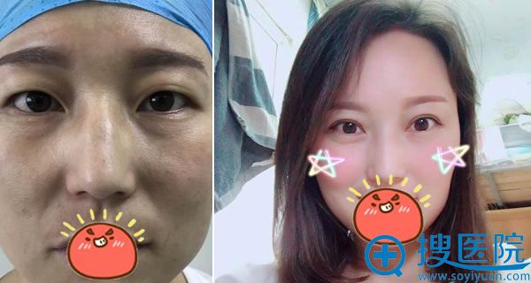 <!--<i data=20240710 data-id=12686></i>-->整形王杨做双眼皮案例 <!--<i data=20240710 data-id=12686></i>-->整形王杨做双眼皮案例