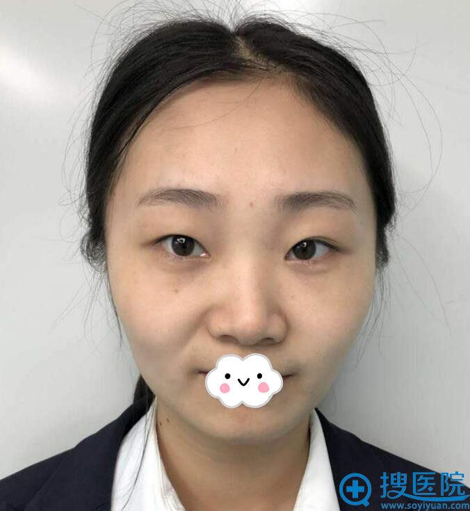 绵阳茗汇肖刚双眼皮+开眼角真人案例 绵阳茗汇肖刚双眼皮+开眼角真人案例