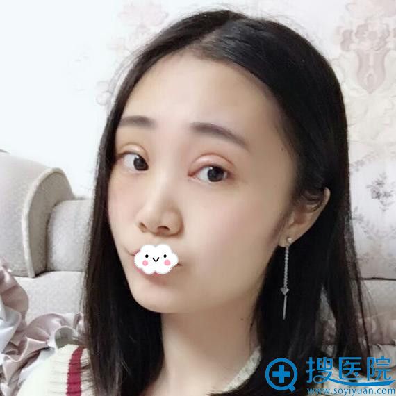 绵阳茗汇肖刚全切双眼皮+开内眼角效果 绵阳茗汇肖刚全切双眼皮+开内眼角效果