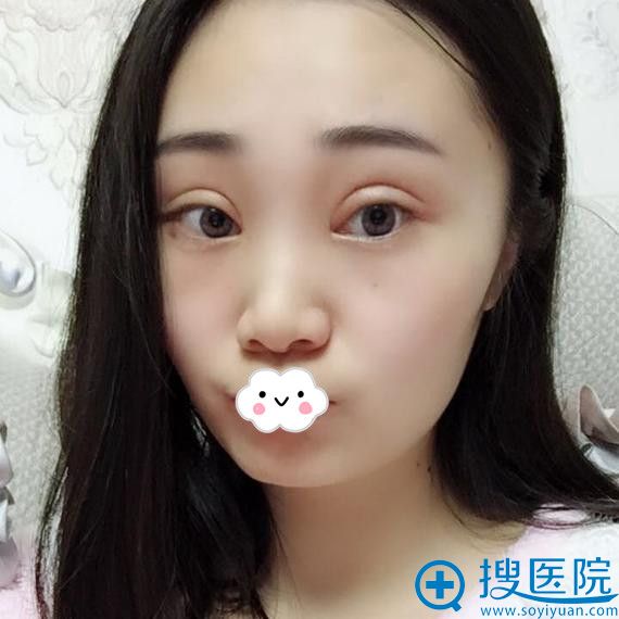 绵阳茗汇肖刚双眼皮+开眼角恢复效果怎么样 绵阳茗汇肖刚双眼皮+开眼角恢复效果怎么样