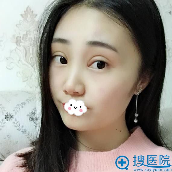 绵阳茗汇肖刚双眼皮案例效果好吗 绵阳茗汇肖刚双眼皮案例效果好吗