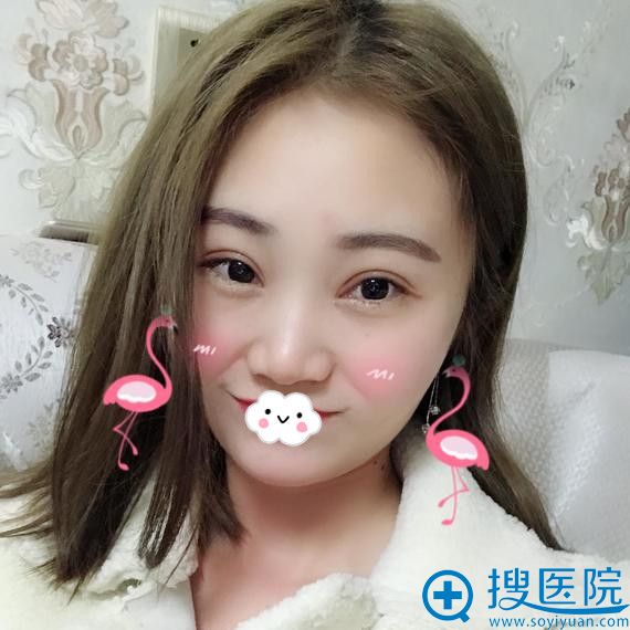 绵阳茗汇肖刚切开双眼皮+开内眼角真人效果 绵阳茗汇肖刚切开双眼皮+开内眼角真人效果