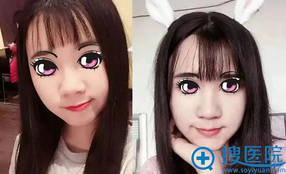 受够了塌鼻子厚鼻头,索性找洛阳维多利亚李迎锋院长做了鼻综合