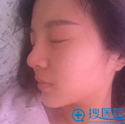 看了金华亚美整形医院张占召的案例后找邓泽臣做了鼻综合隆鼻