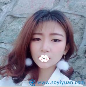 贵阳华美埋线双眼皮真人案例效果图 贵阳华美埋线双眼皮真人案例效果图