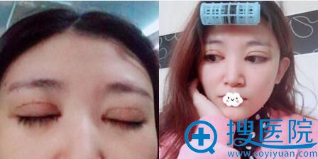 贵阳华美埋线双眼皮术后4天闭眼效果对比 贵阳华美埋线双眼皮术后4天闭眼效果对比
