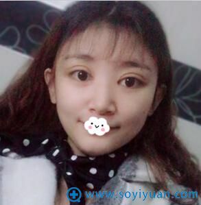 贵阳华美埋线双眼皮做的怎么样?真人案例展示 贵阳华美埋线双眼皮做的怎么样?真人案例展示