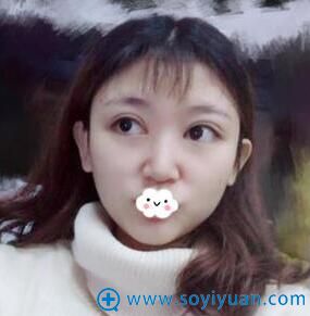 贵阳华美埋线双眼皮20天效果怎么样 贵阳华美埋线双眼皮20天效果怎么样