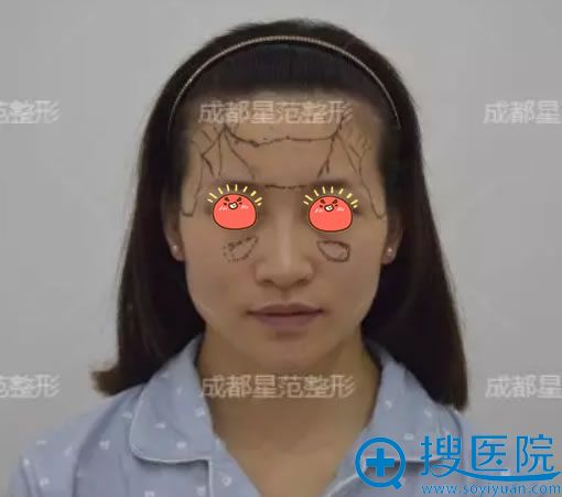 看我找成都星范整形刘向文院长做面部脂肪填充55天效果怎么样