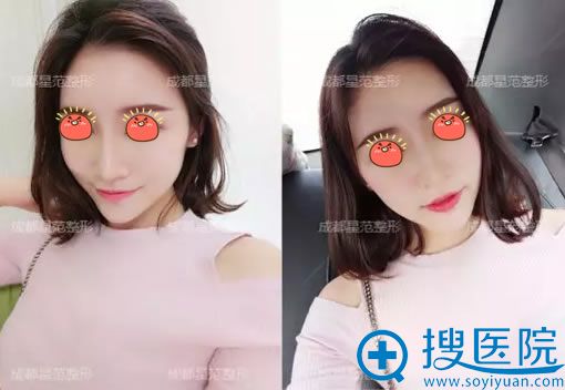在<!--<i data=20240710 data-id=13117></i>-->做脂肪填充7天效果 在<!--<i data=20240710 data-id=13117></i>-->做脂肪填充7天效果