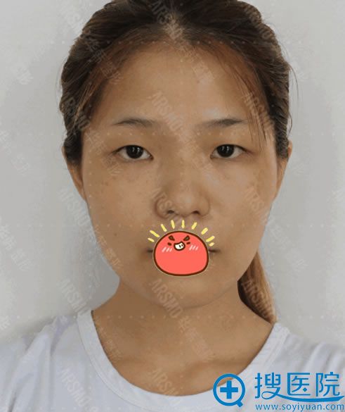 看我在长沙华韩华美把眼睛鼻子和面部脂肪填充都做了变化大吗