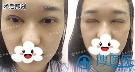 20180802_1533177110350365.jpg 术后即刻.jpg