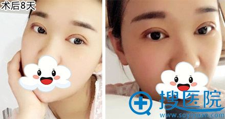 20180802_1533177965256304.jpg 术后8天.jpg