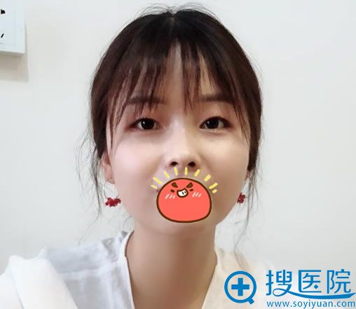 在<!--<i data=20240710 data-id=12473></i>-->博雅做双眼皮和开眼角前 在<!--<i data=20240710 data-id=12473></i>-->博雅做双眼皮和开眼角前