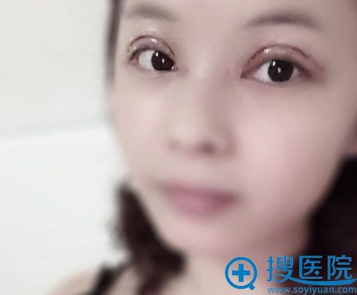 在<!--<i data=20240710 data-id=12473></i>-->博雅做完双眼皮照片 在<!--<i data=20240710 data-id=12473></i>-->博雅做完双眼皮照片