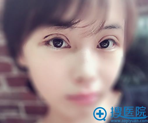 <!--<i data=20240710 data-id=12473></i>-->博雅<!--<i data=20240710 data-id=16562></i>-->做双眼皮6天效果 <!--<i data=20240710 data-id=12473></i>-->博雅<!--<i data=20240710 data-id=16562></i>-->做双眼皮6天效果