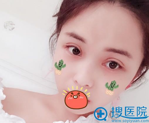 在<!--<i data=20240710 data-id=12473></i>-->博雅做完双眼皮15天效果 在<!--<i data=20240710 data-id=12473></i>-->博雅做完双眼皮15天效果