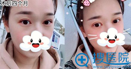 20180802_1533181648117414.jpg 术后4个月.jpg