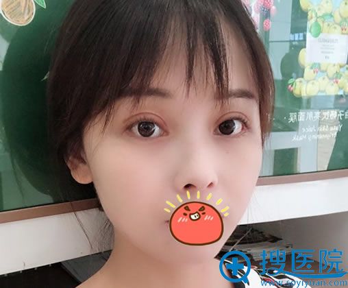 <!--<i data=20240710 data-id=12473></i>-->博雅<!--<i data=20240710 data-id=16562></i>-->双眼皮案例 <!--<i data=20240710 data-id=12473></i>-->博雅<!--<i data=20240710 data-id=16562></i>-->双眼皮案例