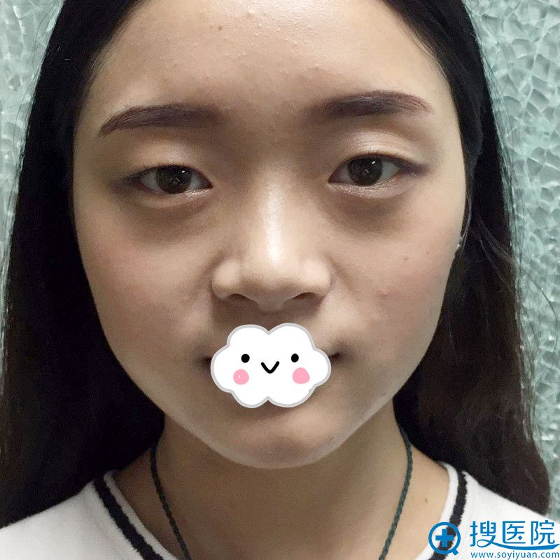 泸州花都割双眼皮怎么样?谢英真人案例 泸州花都割双眼皮怎么样?谢英真人案例