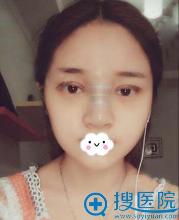 泸州花都谢英切开双眼皮真人案例 泸州花都谢英切开双眼皮真人案例