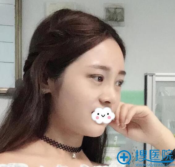 怕埋线双眼皮时间短到泸州花都谢英处做切开双眼皮 怕埋线双眼皮时间短到泸州花都谢英处做切开双眼皮