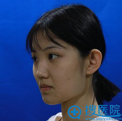 冲着赵贵庆医生的精湛医术才去武汉亚韩整形医院做的下颌角磨骨