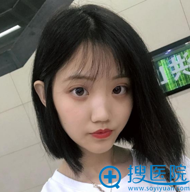 武汉亚韩整形医院赵贵庆下颌角术后半个月 武汉亚韩整形医院赵贵庆下颌角术后半个月