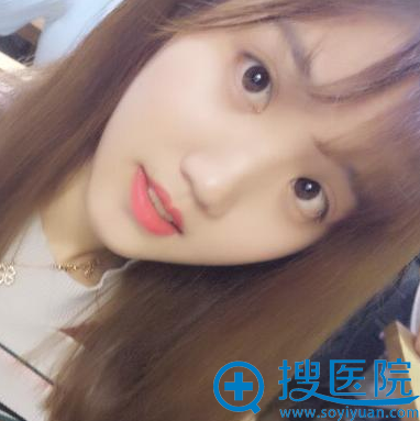 武汉亚韩整形医院赵贵庆下颌角整形案例术后一个月 武汉亚韩整形医院赵贵庆下颌角整形案例术后一个月