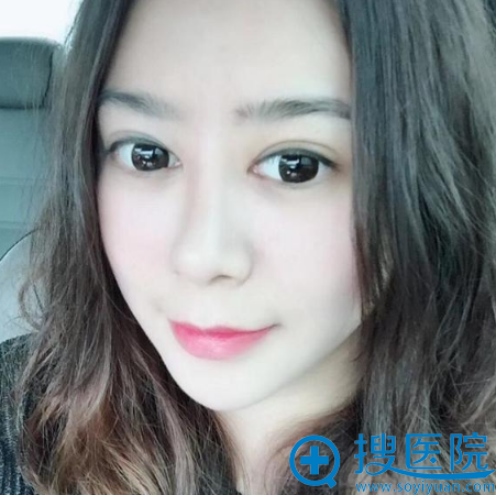 丽水华美丁鑫医生鼻综合隆鼻术后半个月 丽水华美丁鑫医生鼻综合隆鼻术后半个月