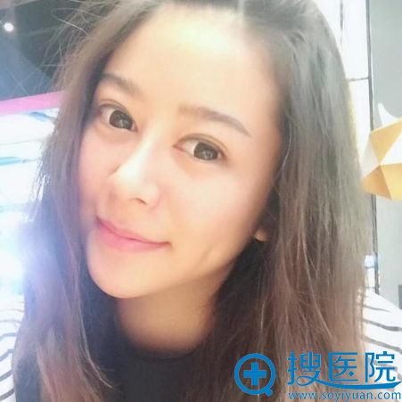 丽水华美整形医院丁鑫鼻综合隆鼻案例术后一个月效果图 丽水华美整形医院丁鑫鼻综合隆鼻案例术后一个月效果图
